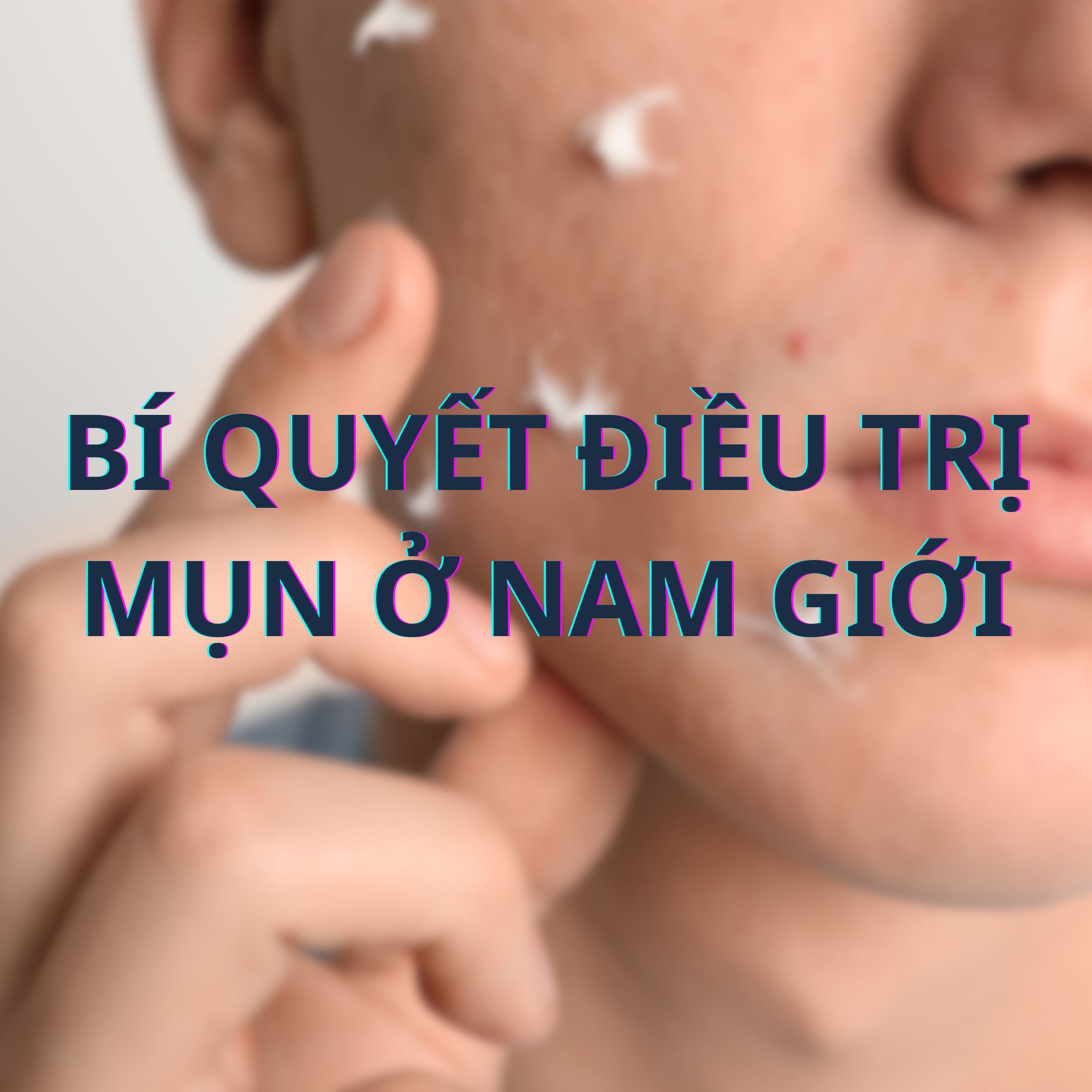 Bí quyết điều trị mụn ở nam giới: Hướng dẫn toàn diện